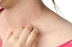 Breathe Clean Bite Mites - pour l'irritation de la peau - comprimés - effets - action