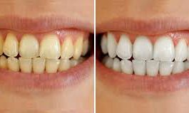 Snowhite Teeth Whitening – pas cher – effets – prix