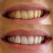 Snowhite Teeth Whitening – composition – effets secondaires – avis